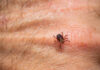 Close-up of a tick on human skin
