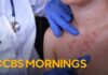 Pennsylvania's 4th measles-related death sparks vaccination concerns