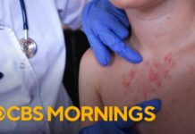 Pennsylvania's 4th measles-related death sparks vaccination concerns