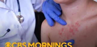 Pennsylvania's 4th measles-related death sparks vaccination concerns